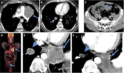 Case report: The activity of multi-kinase VEGF inhibitor, Pazopanib, in metastatic undifferentiated round cell sarcomas harboring EWSR1::CREM fusion: clinicopathological series of two cases and literature review